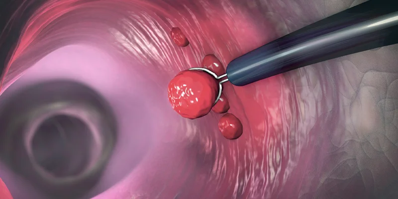 Endoscopic removal of polyps in colon illustration.