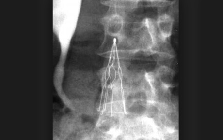 X-ray showing ingested object in abdomen.