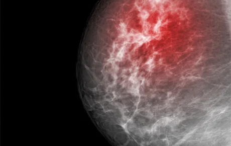 Mammogram showing breast tissue with possible abnormality highlighted.