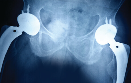 Hip replacement X-ray image.