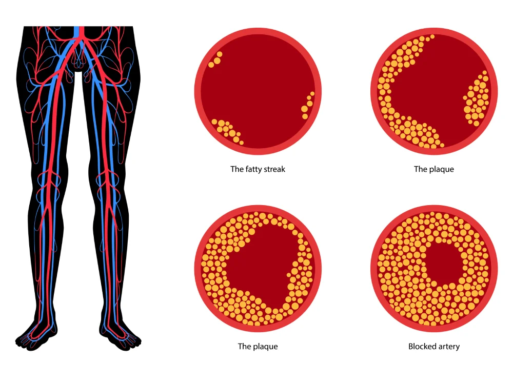 Illustration of artery health progression and blockage stages.