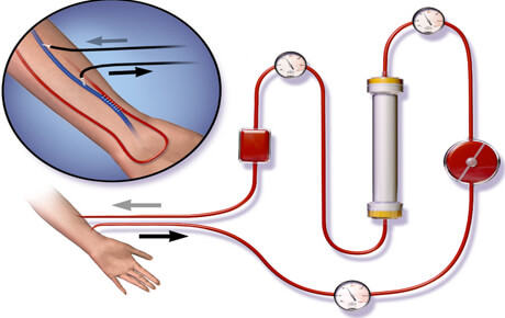 Diagram of blood flow in hemodialysis process.