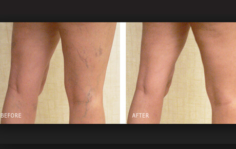 Before and after varicose vein treatment.